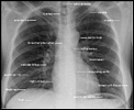 X-rays .....Can you open them ????-pa_chest_xray.gif