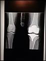 Total knee replacement-image.jpg
